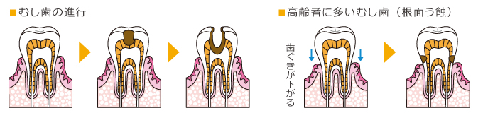 歯周病ってなーに？