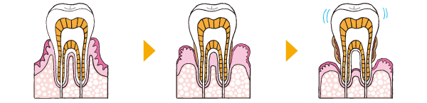 歯周病ってなーに？