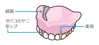総入れ歯の場合