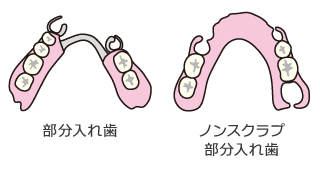 部分入れ歯