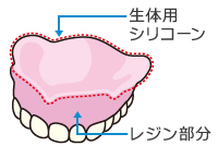 コンフォートデンチャー