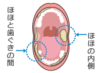 頬の内側 はじめよう やってみよう 口腔ケア