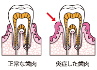 正常な歯肉と炎症した歯肉