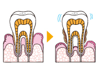 グラグラしている歯